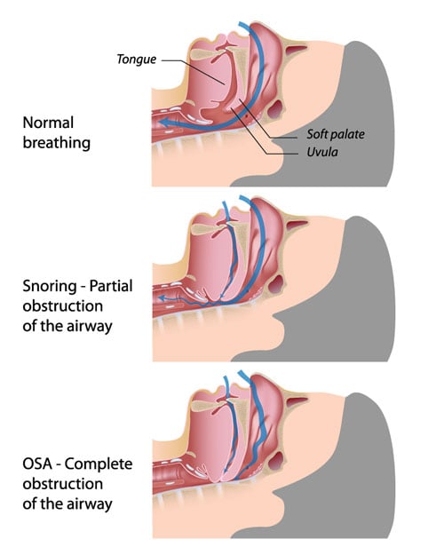 Infographic on Sleep Apnea