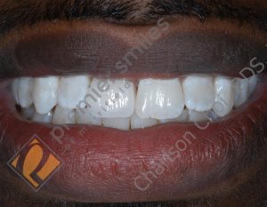 Single implant crown on front tooth - AFTER