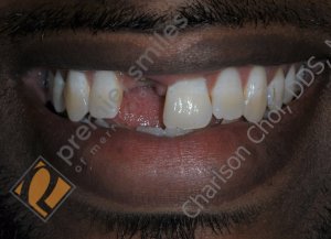 Single implant crown on front tooth - BEFORE
