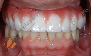 Upper Teeth-in-1-Day (All-on-4) hybrid - AFTER