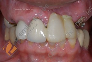Upper Teeth-in-1-Day (All-on-4) hybrid - BEFORE