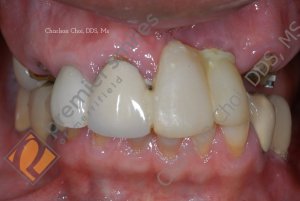 Upper Teeth-in-1-Day (All-on-4) hybrid - BEFORE