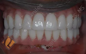 Upper and lower Teeth-in-1-day (All-on-4) hybrid - AFTER