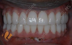 Upper and lower Teeth-in-1-day (All-on-4) hybrid - AFTER