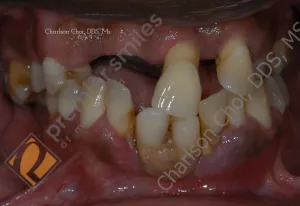 Upper and lower Teeth-in-1-day (All-on-4) hybrid - BEFORE