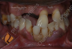 Upper and lower Teeth-in-1-day (All-on-4) hybrid - BEFORE
