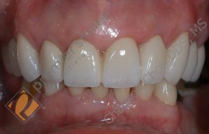 Upper crowns, lower veneers - AFTER