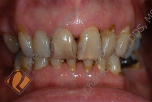 Upper crowns, lower veneers - BEFORE