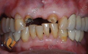 Upper front bridge - BEFORE