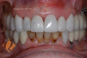 Upper front bridge with gum graft - AFTER