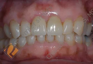 Upper veneers on 2 front teeth - AFTER