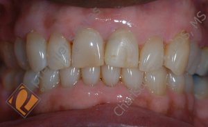 Upper veneers on 2 front teeth - BEFORE