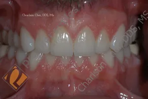 full mouth rehabilitation - AFTER