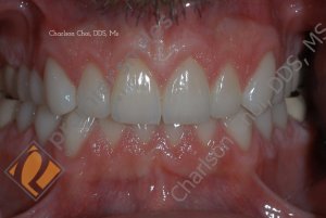 full mouth rehabilitation - AFTER