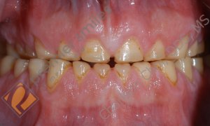 full mouth rehabilitation - BEFORE