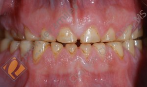 full mouth rehabilitation - BEFORE